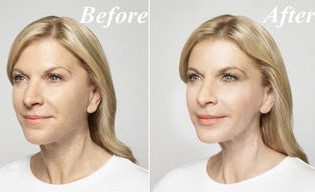 Antes e depois do uso de Goji Cream