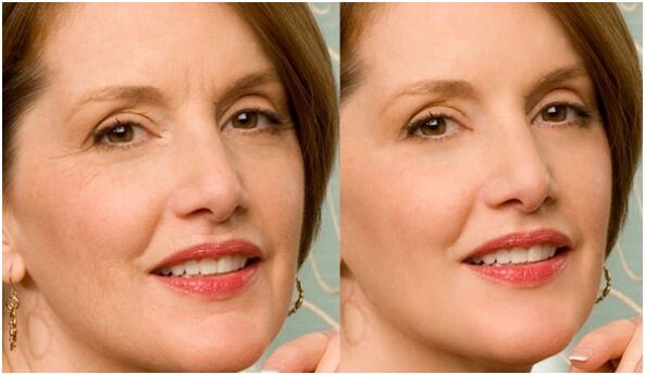 antes e depois do rejuvenescimento da pele facial por plasma