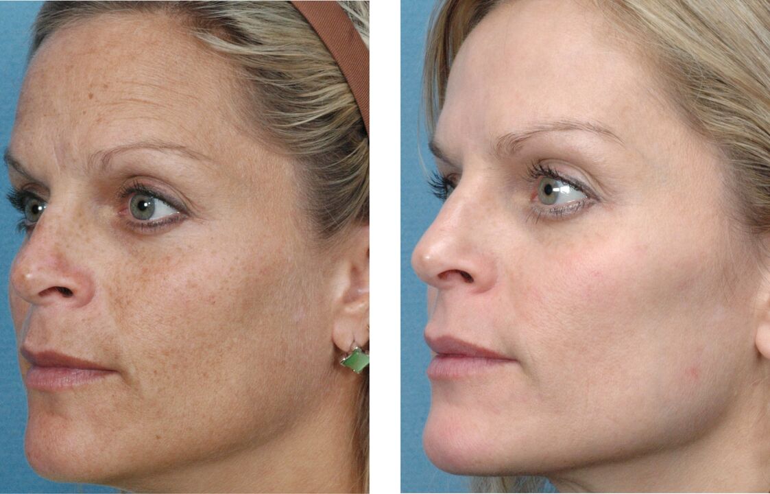 antes e depois do rejuvenescimento da pele foto 1