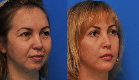 antes e depois do rejuvenescimento da pele com aperto foto 1