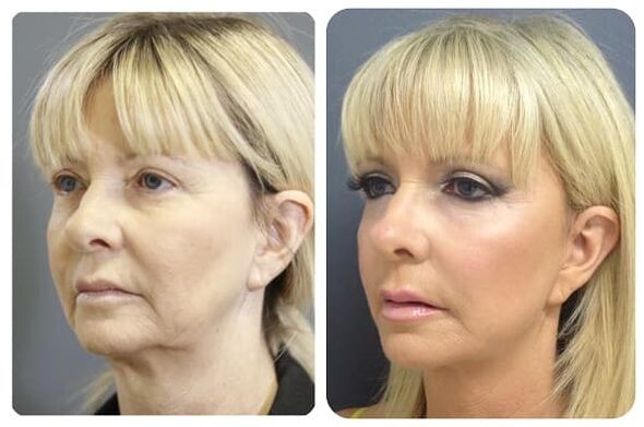 antes e depois do rejuvenescimento da pele com aperto foto 2
