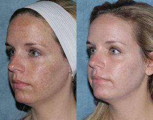 Foto antes e depois fracionário rejuvenescimento facial