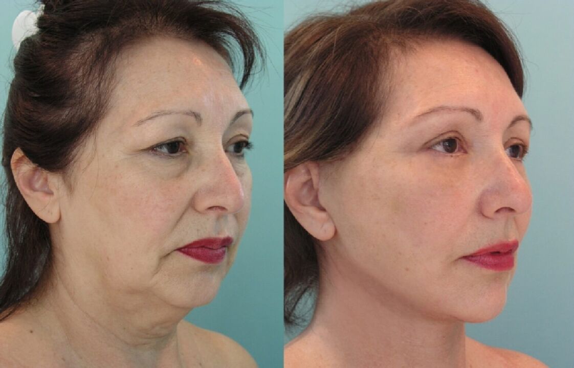 Antes e depois do lifting facial