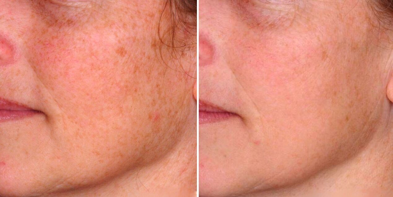 O resultado da fototermólise fracionada é a redução das manchas da idade na pele do rosto. 