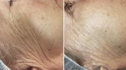 antes e depois do rejuvenescimento da pele a laser