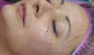 restauração de pele após mesoterapia