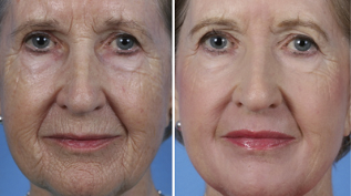 rejuvenescimento facial fracionado antes e depois das fotos