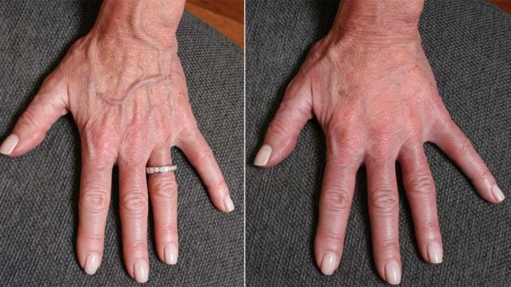 plástico de contorno, foto 1 de rejuvenescimento das mãos antes e depois