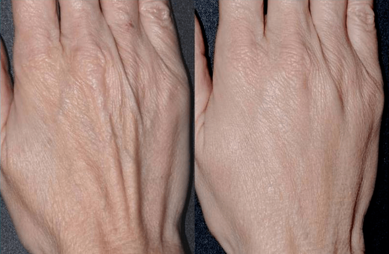 plástico de contorno, foto de rejuvenescimento das mãos 2 antes e depois