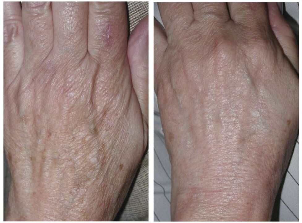 rejuvenescimento a laser das mãos antes e depois das fotos